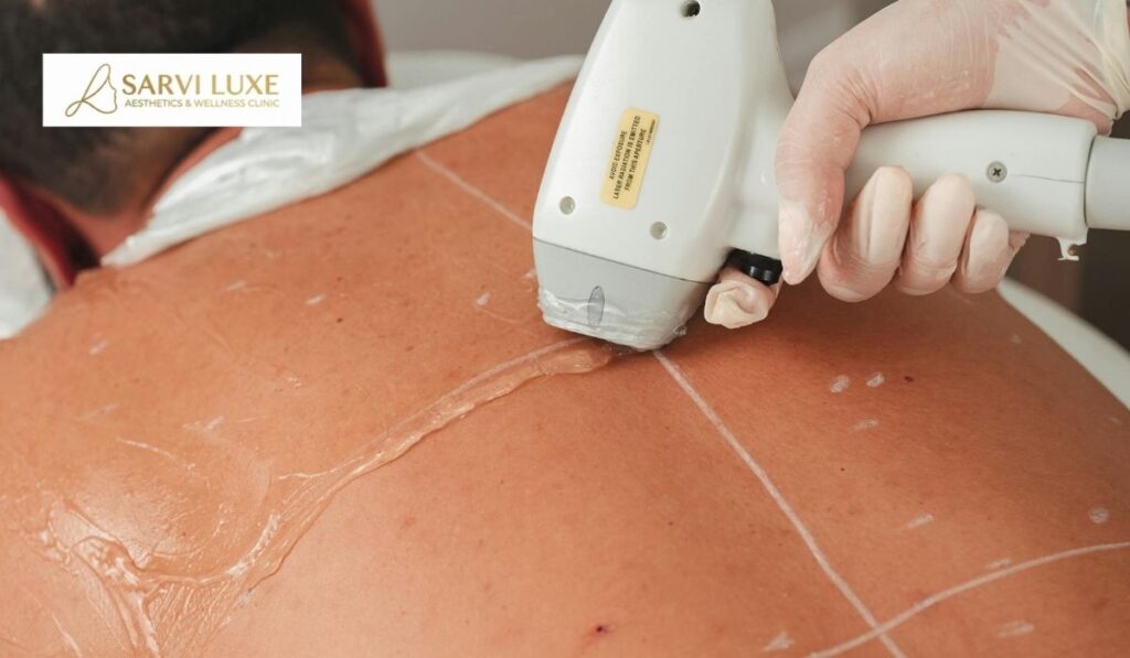 Laser hair removal for Indian skin in Ashok Vihar