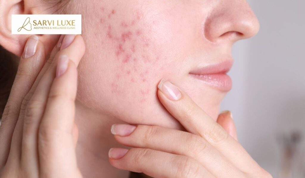Before and after comparison of acne scar treatment results at Sarvi Luxe clinic in Ashok Vihar, Delhi