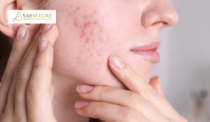 Still Dealing With Acne Scars? Here Is What Treatment Actually Works
