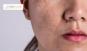 Pigmentation Treatment in Ashok Vihar: Why Some Dark Spots Keep Returning and What Actually Prevents It