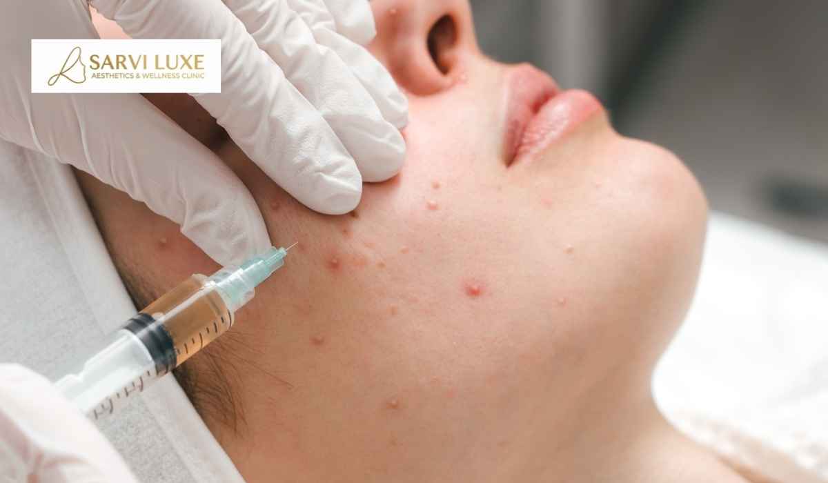 Acne treatment consultation at Sarvi Luxe in Ashok Vihar