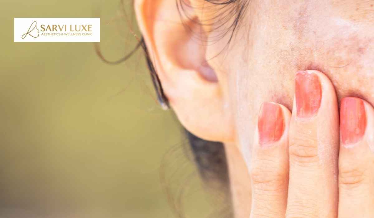 Pigmentation treatment consultation at Sarvi Luxe in Ashok Vihar